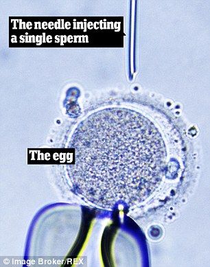 卵母细胞胞浆内单精子注射技术(ICSI)是一种稍微专业一些的试管婴儿技术。